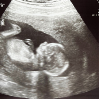 2D ultrasound during pregnancy