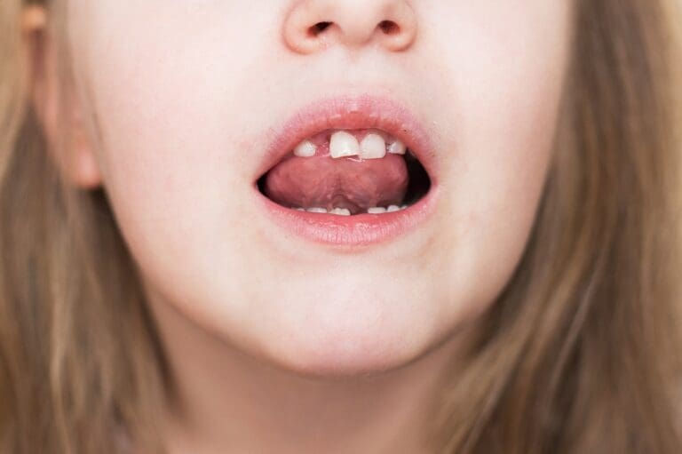 tongue-thrust-2-768x511.jpg