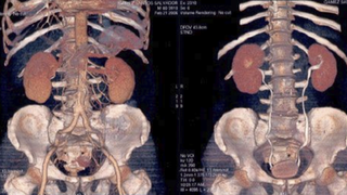 Reconocen especialistas del HCG aumento en la detección incidental de cáncer de riñón