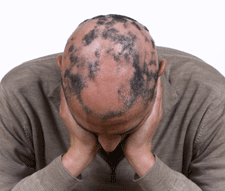 alopecia-hair-loss