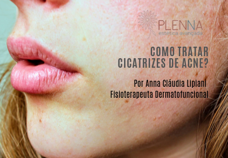 Como tratar cicatrizes de acne