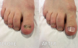 toenail reconstruction Northwich