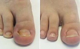 toenail-surgery-before-and-after