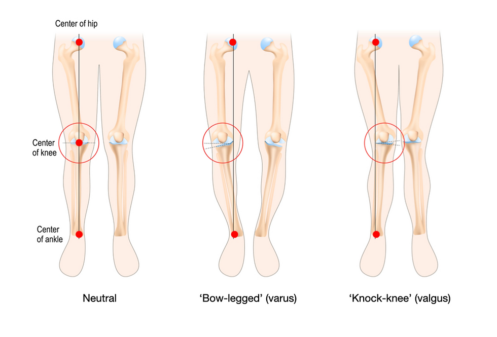 Lower limb alignment - normal, varus and valgus