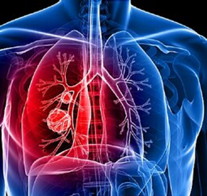 Lung Cancer.png