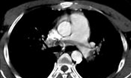 Pulmonary Embolism.png