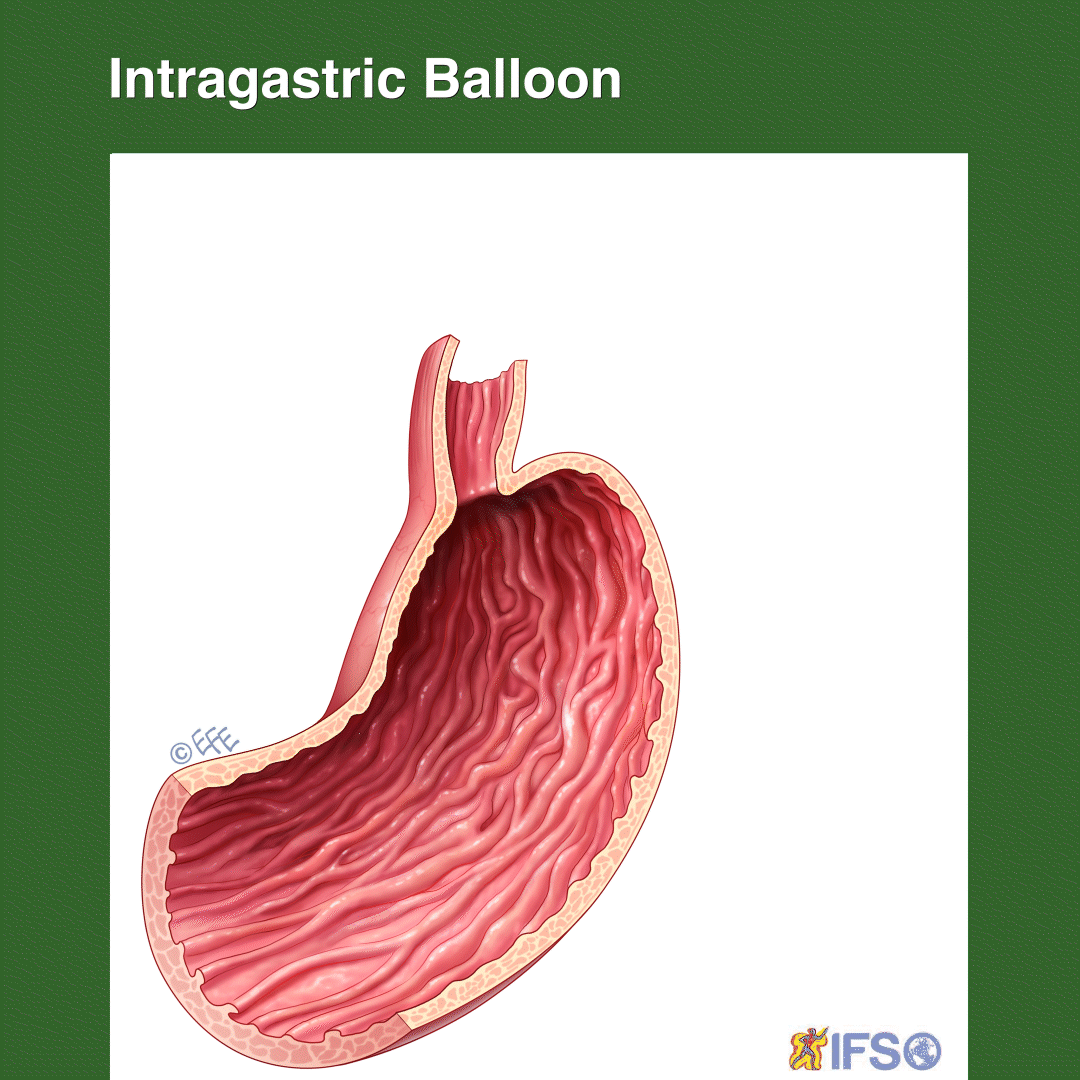 Gastric Balloon
