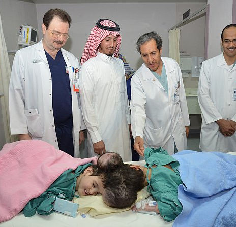 نجاح مميز لعملية فصل التوأم (رنا ورنيم) .. خلال 14 ساعة و8 مراحل معقدة