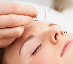 acupuntura