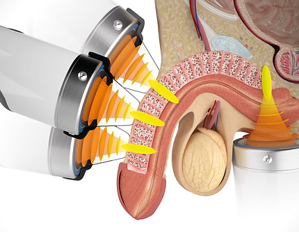 focused-shockwave-therapy-for-ed-at-home-scaled.jpeg