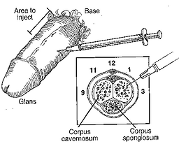 Penile Injection 2 oclock