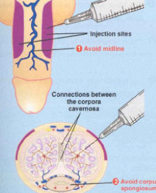 Penile Injection close up