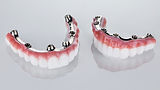 IMPLANT RETAINED DENTURES