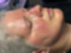 oncology facial before 1