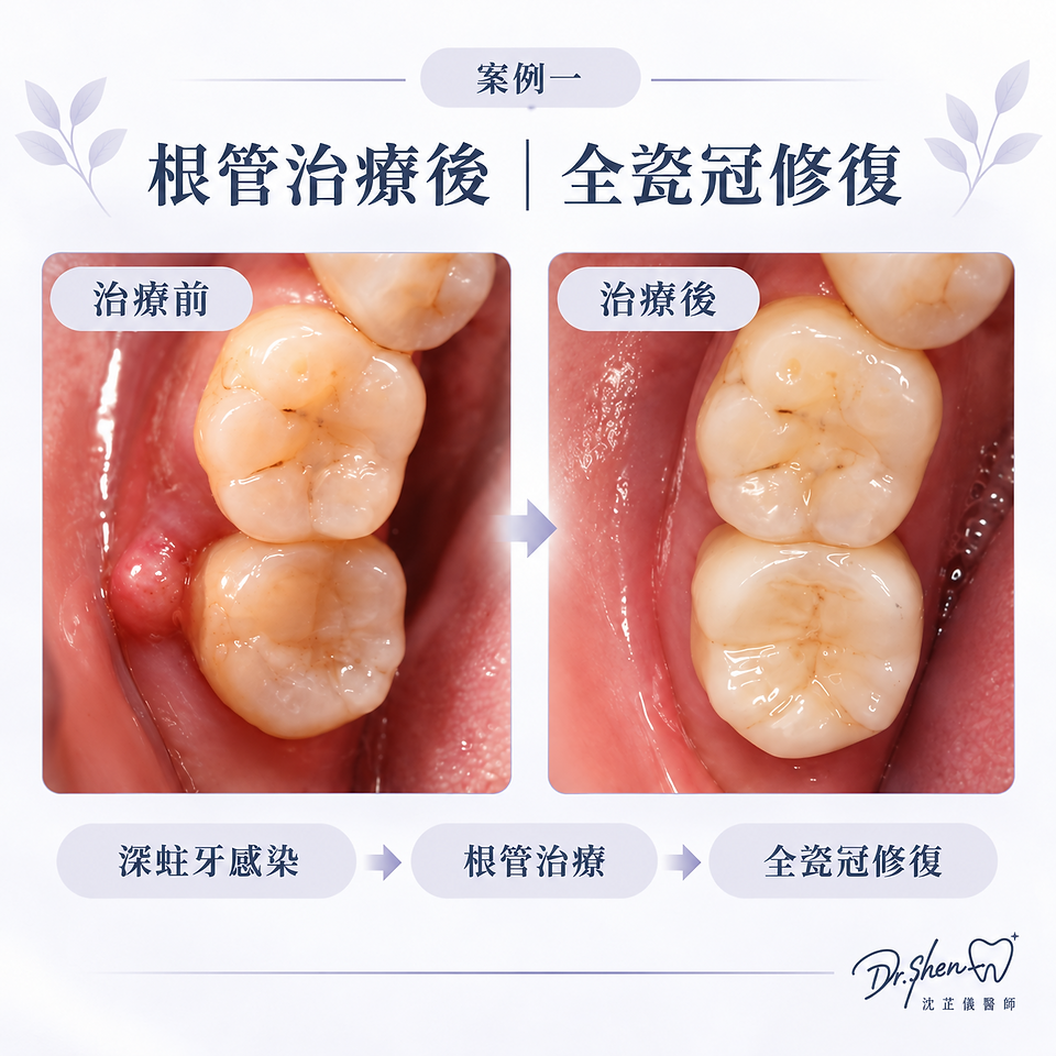 根管治療後以全瓷冠修復的病例影像(IG-038)