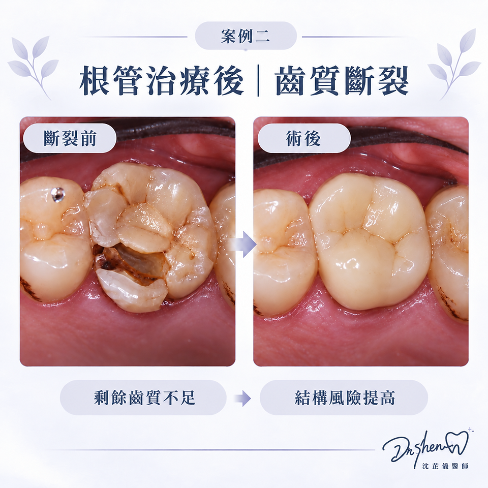 根管治療後牙齒發生齒質斷裂的病例影像(IG-048)