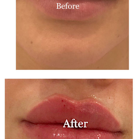 Lip Augmentation