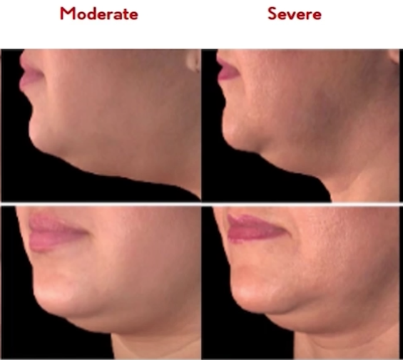 The apperance of moderate and severe double chins in oblique and project views 