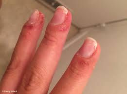 Peut‑on dire qu’un vernis gel est “non allergène” ?