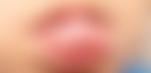 What is Tongue Thrust and how to stop it?