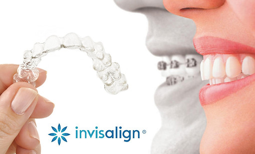 INVISALIGN, orthondontie invisible, TOURET Nathan, Dentiste, Nice