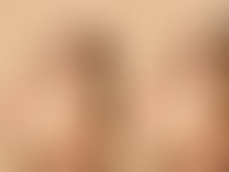 La rinomodelación y la armonización de puntos clave (mentón, pómulos, sienes) exigen un conocimiento profundo de la física de fluidos (reología).