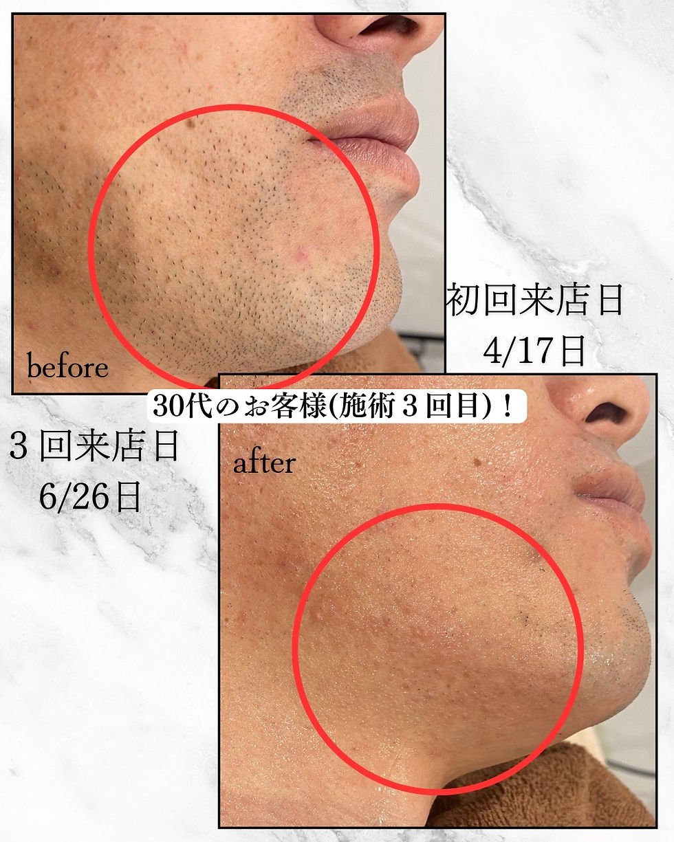 沖縄市のメンズ脱毛専門店｜夕方の青ヒゲを根本から改善するなら沖縄メンズ脱毛Lumosへ