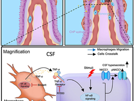 Choroid plexus CCL2‒CCR2 signaling orchestrates macrophage recruitment and cerebrospinal fluid hypersecretion in hydrocephalus.