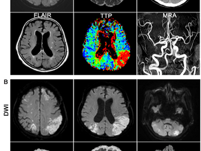Clinical case of cns-involved refractory thrombotic thrombocytopenic purpura. J Neurointensive Care. 2021 [교신저자]