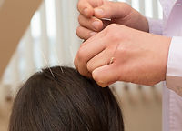 Acupuncture
