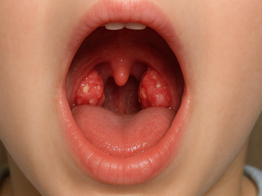child with tonsil enlargement or tonsillar hypertrophy
