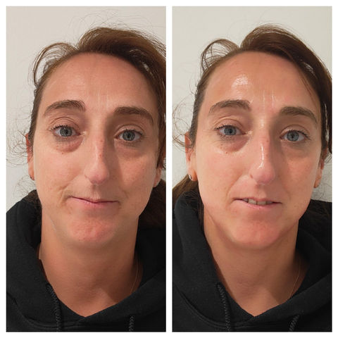 Platinum Facial Before and After.jpg