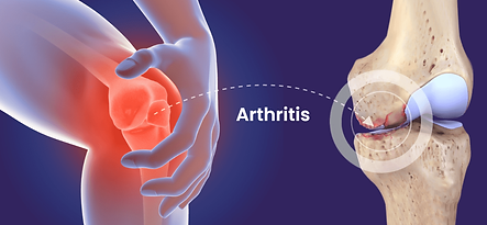 knee pain