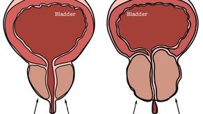 Benign Prostatic Hyperplasia (BPH)