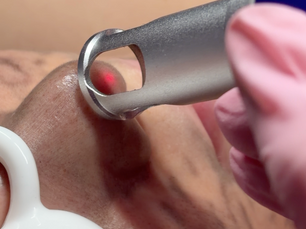Carbon Glow Facial vs Chemical Peels: Which One Does Your Skin Actually Need?