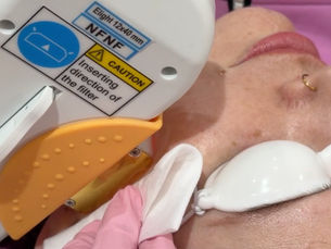 What Can IPL Actually Treat? (Hint: It's So Much More Than Skin Rejuvenation)
