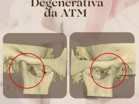 Doenças degenerativas da ATM