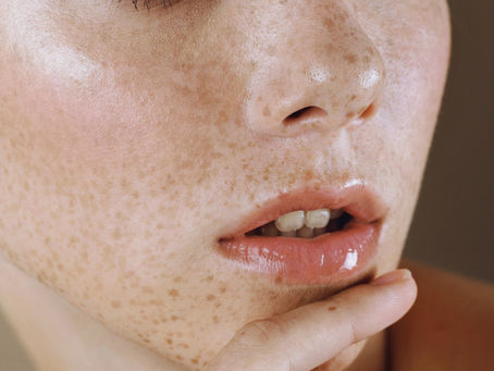 Freckles on Lips? Causes, Risks, and Remedies