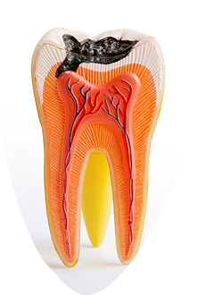 affordable root canal