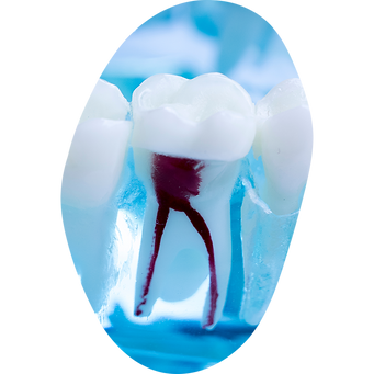 Root Canal Treatment