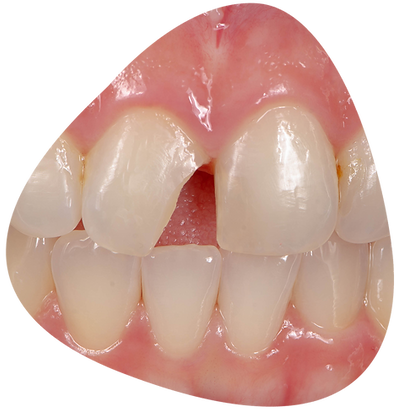Broken tooth repair