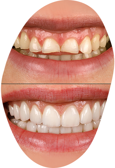 Dental crowns