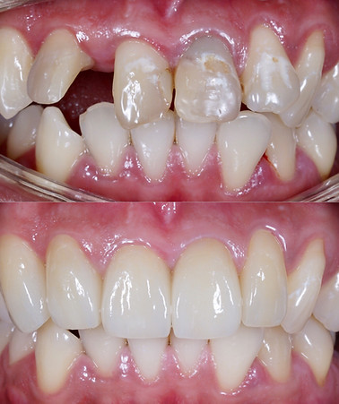 Loose crown emergency
