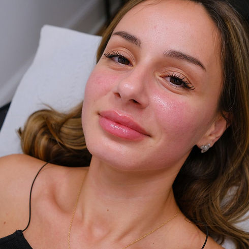 Honey Lips London lip filler clinic.jpg