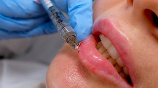 Next step in lip fillers: moving away from trends