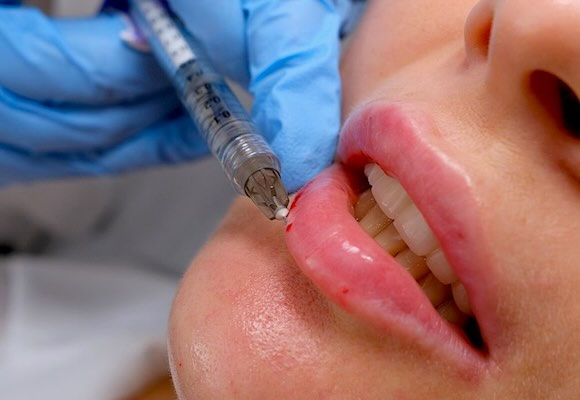 Next step in lip fillers: moving away from trends