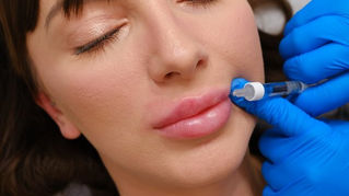 How noticeable is 0.5 ml lip filler? 