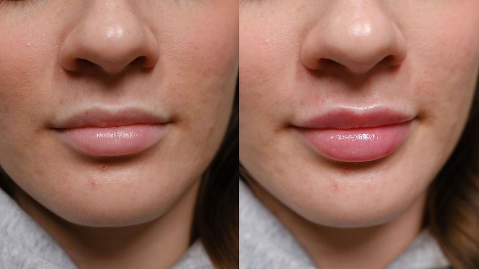 How noticeable is 0.5 ml lip filler