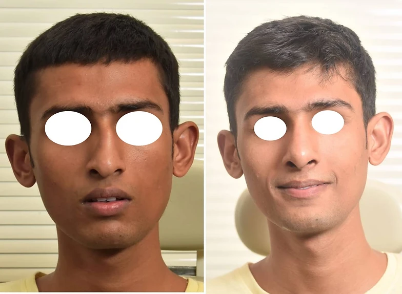 Crooked Nose Correction Cosmeticrhinoplasty