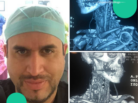 Tumor En Cuello Derecho